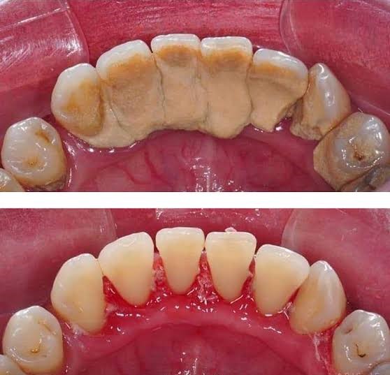 Teeth Cleaning & Polishingदांतों का पीलापन कैसे दूर करें दातों का प्रत्यारोपण दांतो की असामान्यता दांतो की सूजन कैसे दूर करें दांतों की सड़न कैसे दूर करें दांतों की सफाई करने वाला डॉक्टर दांतों की सफाई के नुस्खे दांतों की सफाई कैसे होती है दांतों की सफाई क्यों जरूरी है दांतों की सफाई डॉक्टर कैसे करते हैं दातों की सफाई मशीन द्वारा दांतो के डॉक्टर दांतों में इंफेक्शन का इलाज