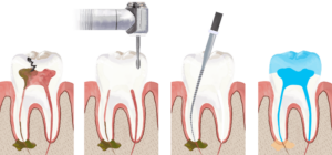 tooth pain and patient fear