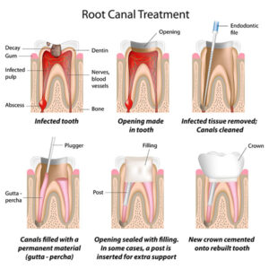 tooth pain and patient fear